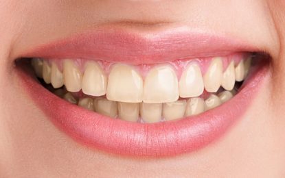 How to Enjoy Cheaper Professional Teeth Whitening Services