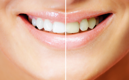 Advantages of Laser Gum Treatments