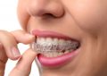 What Causes An Overbite Or Underbite And How An Orthodontist Can Help