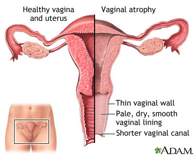 Why Does Intercourse Cause Vaginal Dryness? Medical & Lifestyle Factors Explained